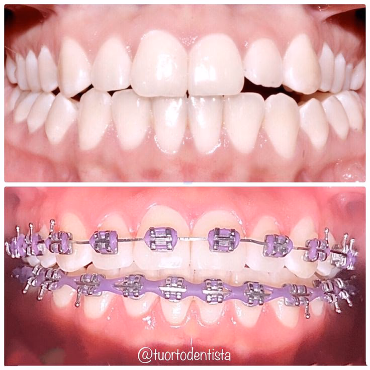 ¿Cuál es el mejor color de brackets para piel morena?