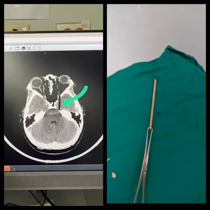 ¿Se pueden coser las tortillas después de haberse abierto la cabeza?