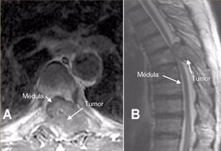 ¿Cuáles son las consecuencias de la compresión tumoral?
