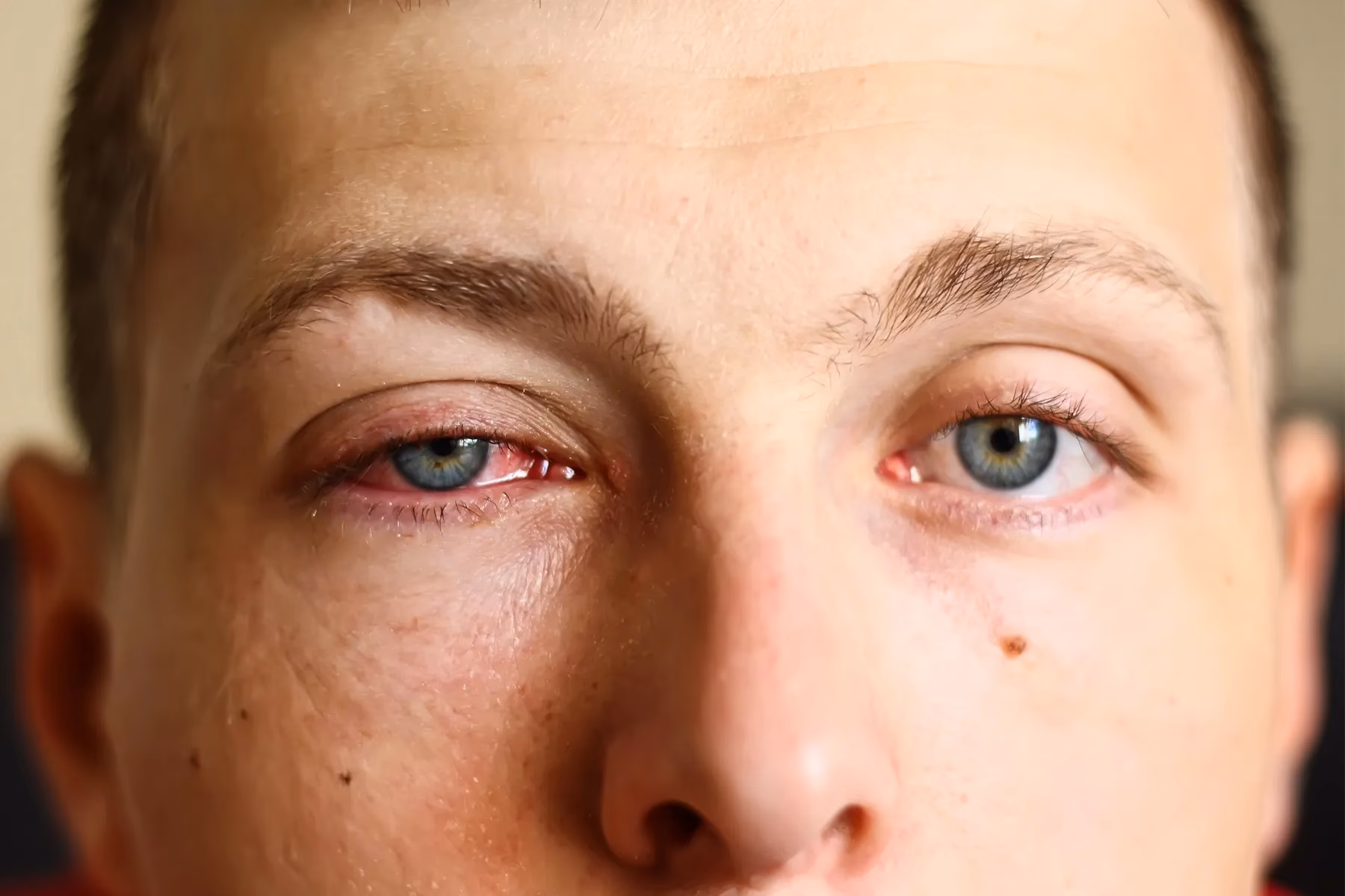 ¿Cómo se transmite la conjuntivitis?