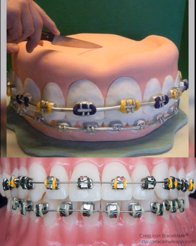 ¿Cómo cuidar tus brackets?