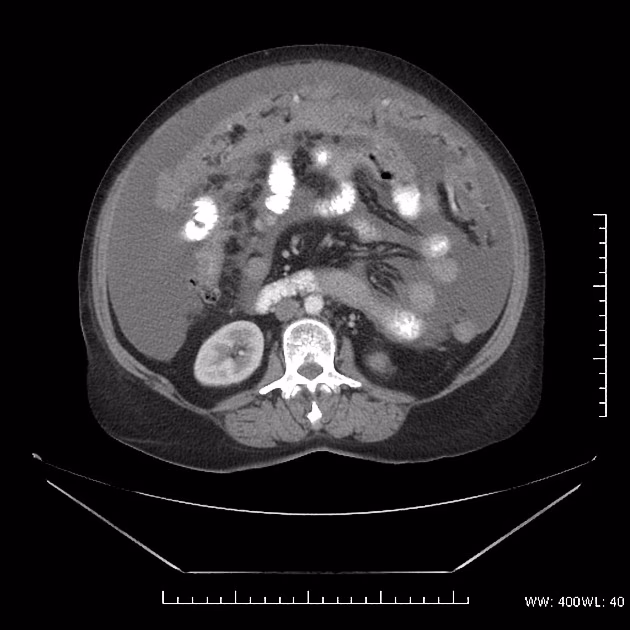 ¿Cómo saber si una torta omental es incierta?